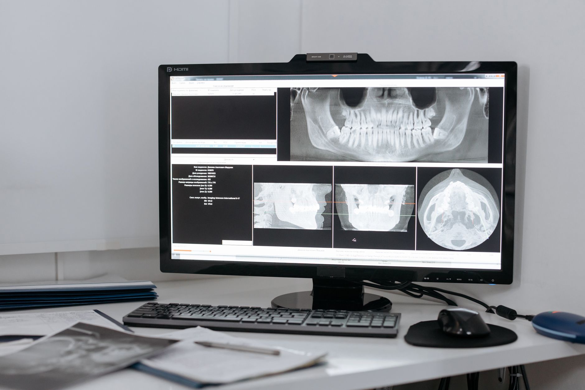 A computer monitor showing panoramic and cross-sectional cone beam CT views on a clinic desk